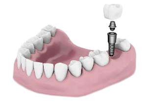 dentalimplants-copy-300x210
