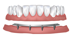 denture2