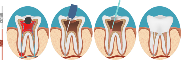 root canal process