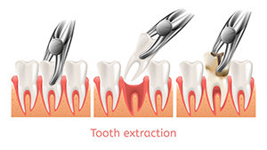 Tooth extraction