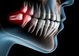 wisdom tooth graphic xray